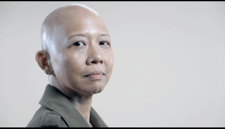 एलोपेसिया यूनिवर्सालिस (Alopecia Universalis)