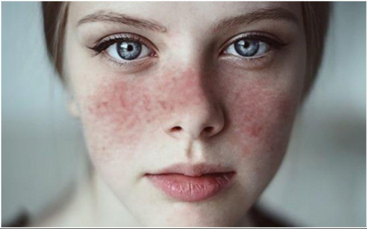 कोलेजन वैस्कुलर रोगों की त्वचीय अभिव्यक्तियाँ (Skin Manifestations of Collagen Vascular Diseases)