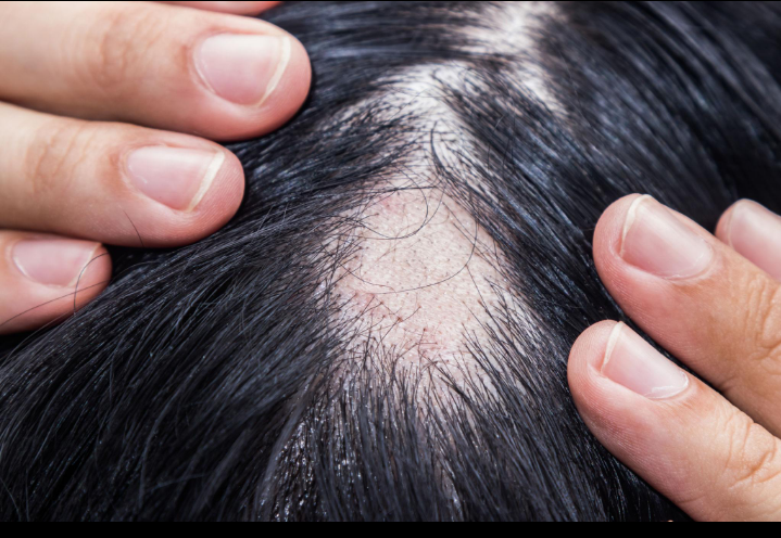 Alopecia (Hair Loss)