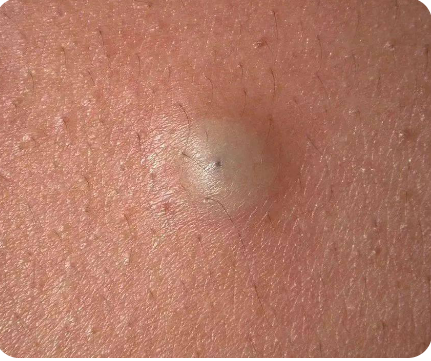 त्वचा के नीचे बनने वाली गांठों (Subcutaneous Nodules) का विभेदक निदान