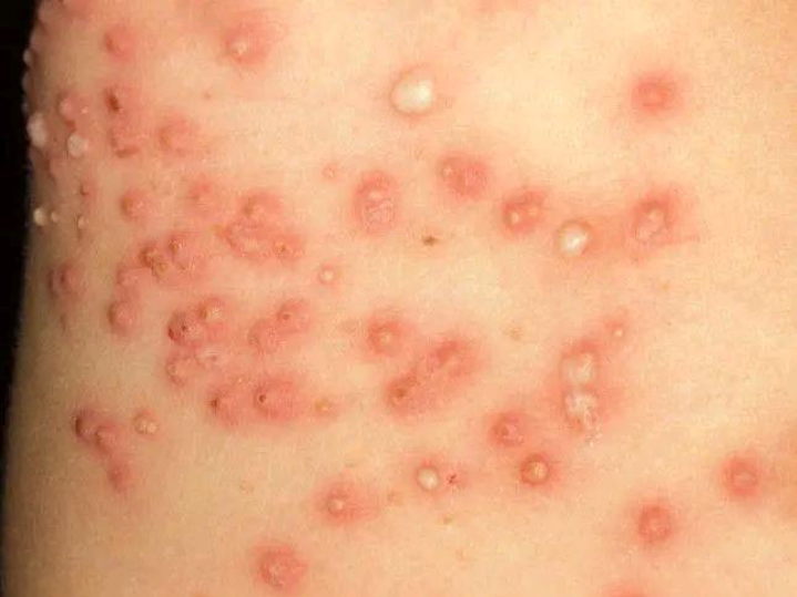 बुखार के साथ चकत्ते (Rash with Fever) का विभेदक निदान (Differential Diagnosis)