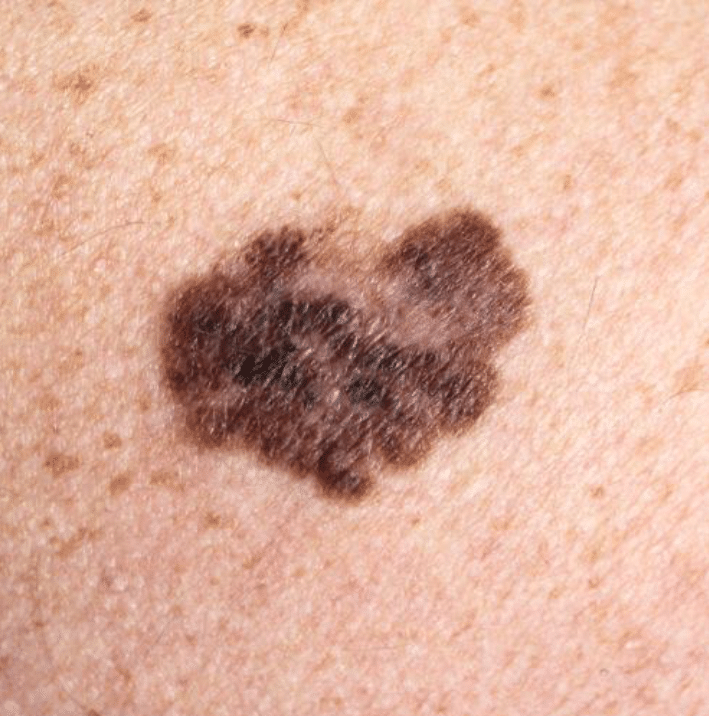 Melanoma: The Most Serious Type of Skin Cancer