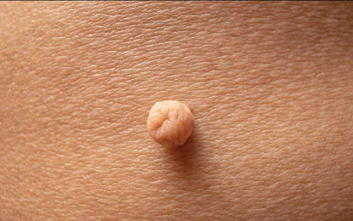 त्वचीय हाइपरप्लासिया (Cutaneous Hyperplasias)