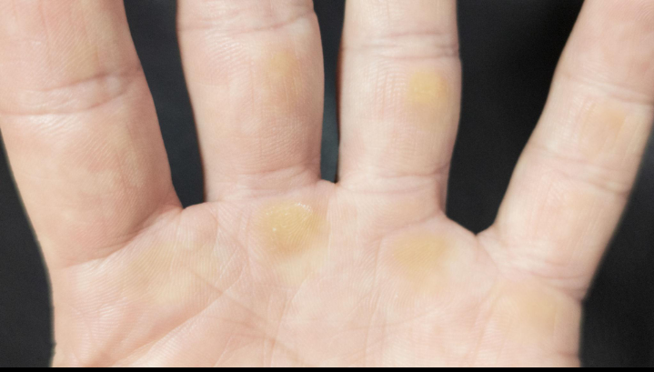 Callus (Callosity)