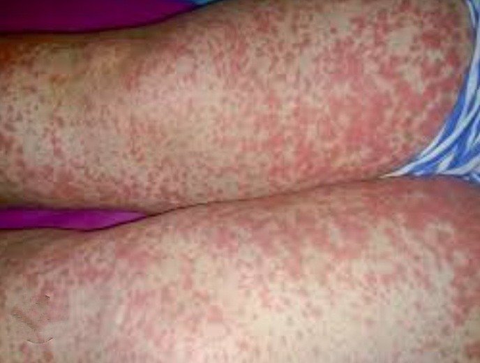 Differential Diagnosis of Vascular Rash