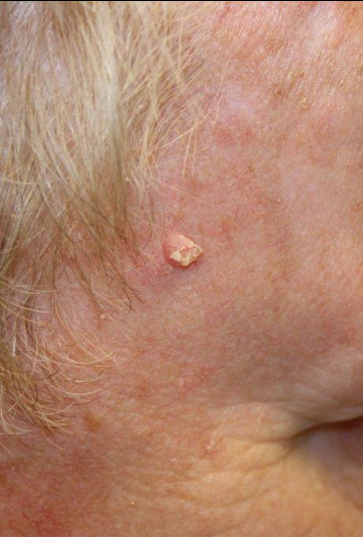 स्क्वैमस सेल कार्सिनोमा (Squamous Cell Carcinoma)