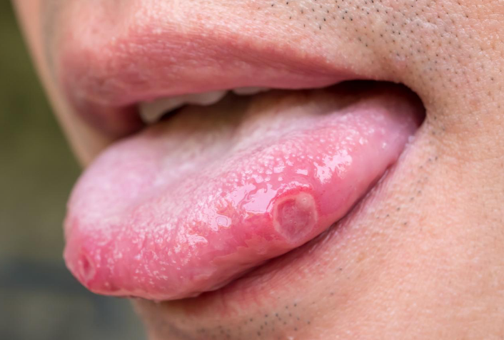 Aphthous Ulcer (Canker Sores)