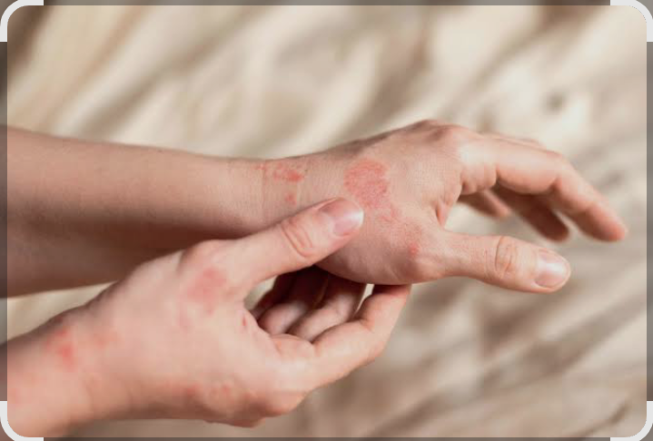 Pruritus (Itching)