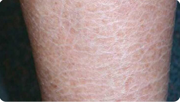 इक्थियोसिस (Ichthyosis)